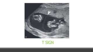 Multifetal pregnancy RADIOLOGY | PPTX
