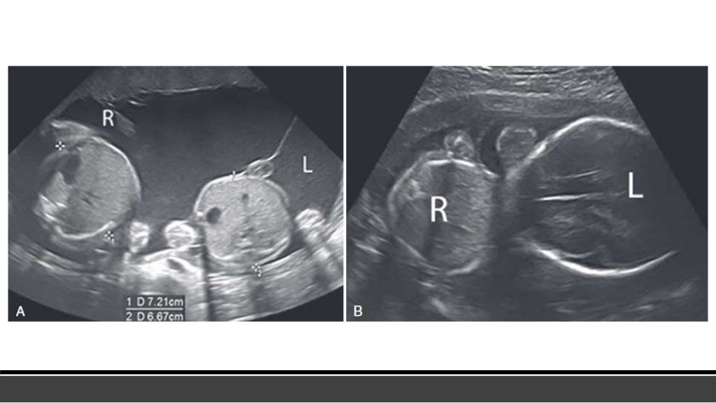 Multifetal pregnancy RADIOLOGY