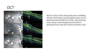 OCT
All the 3 areas of foci show profound re-modelling
of outer retina with a bump (nodular lesion at and
above the level of RPE) for all 3 foci. The overlying
inner retinal is also disorganised and there is
pooling of fluid under the retinal around the 3 foci
 