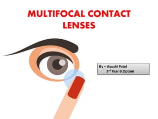 MULTIFOCAL CONTACT
LENSES
By – Ayushi Patel
3rd Year B.Optom
 