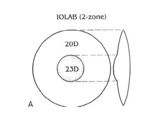 Multifocal iols | PPTX