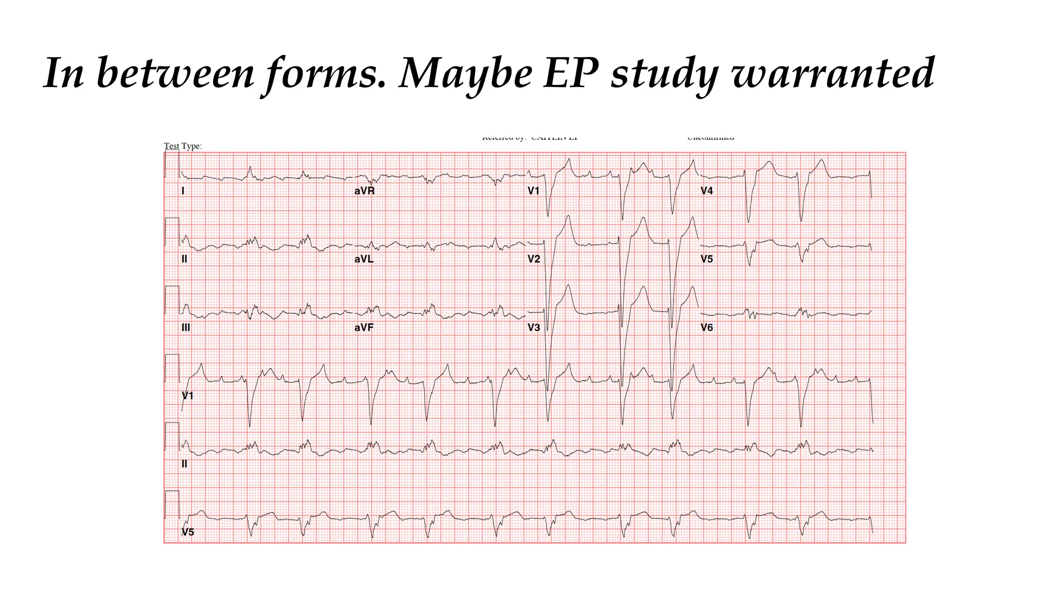 Multilevel AV block: benign and malignant | PPT