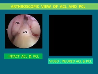 Multiligament Injury of Knee and ACL & PCL Reconstruction | PPTX