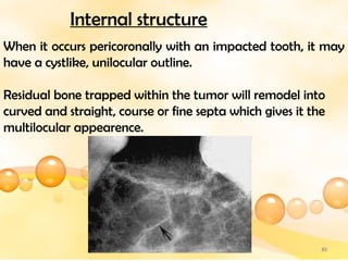 Multilocular Letter multilocular radiolucencies of the jaw... | PPTX
