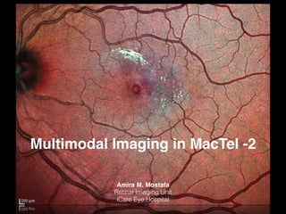 Multimodal Imaging in MacTel -2
Amira M. Mostafa
Retinal Imaging Unit
iCare Eye Hospital
 
