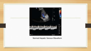 Normal Hepatic Venous Waveform
 