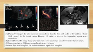 (A)Duplex US image 1 day after transplant shows absent diastolic flow, with an RI of 1.0 and low velocity
(34.1 cm/sec) in the hepatic artery. Doppler US owing to concern for impending hepatic artery
thrombosis.
(B)Power Doppler US image 3 days after transplant shows a complete loss of flow in the hepatic artery.
(C)Contrast-enhanced MR image shows hepatic artery occlusion
Fourteen days after transplant, the patient underwent repeat liver transplant.
Fig: 4
 