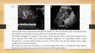 Early hepatic artery thrombosis with hepatic infarct in a 44-year-old man with markedly elevated
liver function test results at routine follow-up 2 weeks after transplant.
(A) Duplex Doppler US image of the region of the hepatic artery at the porta hepatis shows
trace remnant flow with poor arterial pulsatility, suggestive of impending hepatic artery
thrombosis. A strong arterial tracing was seen in the celiac axis, but the hepatic artery origin
could not be found (not shown).
(B) Transverse gray-scale US image of the left hepatic lobe shows a peripheral wedge-shaped
hypoechoic heterogeneous area (arrow) consistent with hepatic infarct.
Fig: 5
 