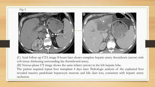 (C) Axial follow-up CTA image 8 hours later shows complete hepatic artery thrombosis (arrow) with
soft-tissue thickening surrounding the thrombosed artery.
(D) Venous phase CT image shows the same infarct (arrow) in the left hepatic lobe.
The patient required repeat liver transplant 4 days later. Pathologic analysis of the explanted liver
revealed massive panlobular hepatocyte necrosis and bile duct loss, consistent with hepatic artery
occlusion.
Fig: 5
 