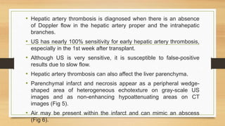 • Hepatic artery thrombosis is diagnosed when there is an absence
of Doppler flow in the hepatic artery proper and the intrahepatic
branches.
• US has nearly 100% sensitivity for early hepatic artery thrombosis,
especially in the 1st week after transplant.
• Although US is very sensitive, it is susceptible to false-positive
results due to slow flow.
• Hepatic artery thrombosis can also affect the liver parenchyma.
• Parenchymal infarct and necrosis appear as a peripheral wedge-
shaped area of heterogeneous echotexture on gray-scale US
images and as non-enhancing hypoattenuating areas on CT
images (Fig 5).
• Air may be present within the infarct and can mimic an abscess
(Fig 6).
 
