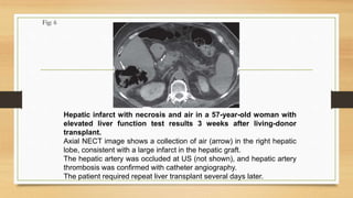 Fig: 6
Hepatic infarct with necrosis and air in a 57-year-old woman with
elevated liver function test results 3 weeks after living-donor
transplant.
Axial NECT image shows a collection of air (arrow) in the right hepatic
lobe, consistent with a large infarct in the hepatic graft.
The hepatic artery was occluded at US (not shown), and hepatic artery
thrombosis was confirmed with catheter angiography.
The patient required repeat liver transplant several days later.
 