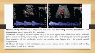 Hepatic artery stenosis in a 58-year-old man with new increasing alkaline phosphatase and
transaminase levels 5 weeks after liver transplant.
(A) Duplex US image of the main hepatic artery at the porta hepatis shows a borderline low RI and mild
parvus tardus waveform, with blunting of the systolic peak. This subtle change in waveform prompted
close evaluation of the intrahepatic arteries and proximal main hepatic artery for possible arterial
complications.
(B) Duplex US image of the intrahepatic artery shows a classic parvus tardus waveform and low RI,
suggestive of hepatic artery stenosis.
 