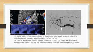 (C) On the duplex US interrogation image of the proximal main hepatic artery, the stenosis is
directly visualized, with color aliasing and a PSV of 593 cm/sec.
(D) Catheter angiographic findings confirm the stenosis (arrow). The patient was treated with
angioplasty, and his liver function test results dramatically improved the week following treatment.
 