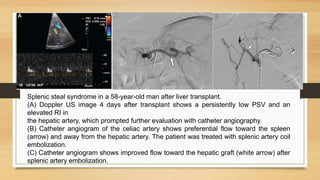 Splenic steal syndrome in a 58-year-old man after liver transplant.
(A) Doppler US image 4 days after transplant shows a persistently low PSV and an
elevated RI in
the hepatic artery, which prompted further evaluation with catheter angiography.
(B) Catheter angiogram of the celiac artery shows preferential flow toward the spleen
(arrow) and away from the hepatic artery. The patient was treated with splenic artery coil
embolization.
(C) Catheter angiogram shows improved flow toward the hepatic graft (white arrow) after
splenic artery embolization.
 
