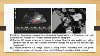 Portal vein thrombosis involving the main and right portal veins in a 58-year-old man with
abnormal liver function test results 8 months after liver transplant.
(A)Doppler US image shows an echogenic thrombus filling the right portal vein, with a
complete lack of flow. The spectral waveform findings are due to the adjacent right
hepatic artery.
(B)Contrast-enhanced CT image shows a filling defect extending from the portal
confluence (arrow) into the right portal vein (not shown), consistent with thrombus.
 