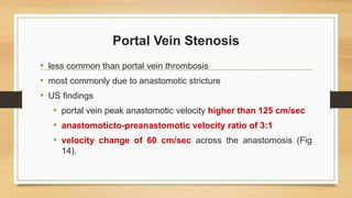 Portal Vein Stenosis
• less common than portal vein thrombosis
• most commonly due to anastomotic stricture
• US findings
• portal vein peak anastomotic velocity higher than 125 cm/sec
• anastomoticto-preanastomotic velocity ratio of 3:1
• velocity change of 60 cm/sec across the anastomosis (Fig
14).
 