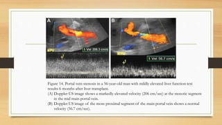 Figure 14. Portal vein stenosis in a 56-year-old man with mildly elevated liver function test
results 6 months after liver transplant.
(A) Doppler US image shows a markedly elevated velocity (206 cm/sec) at the stenotic segment
in the mid main portal vein.
(B) Doppler US image of the more proximal segment of the main portal vein shows a normal
velocity (56.7 cm/sec).
 