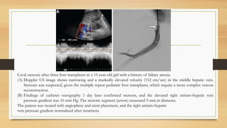 Caval stenosis after three liver transplants in a 15-year-old girl with a history of biliary atresia.
(A) Doppler US image shows narrowing and a markedly elevated velocity (152 cm/sec) in the middle hepatic vein.
Stenosis was suspected, given the multiple repeat pediatric liver transplants, which require a more complex venous
reconstruction.
(B) Findings of catheter venography 1 day later confirmed stenosis, and the elevated right atrium–hepatic vein
pressure gradient was 16 mm Hg. The stenotic segment (arrow) measured 5 mm in diameter.
The patient was treated with angioplasty and stent placement, and the right atrium–hepatic
vein pressure gradient normalized after treatment.
 