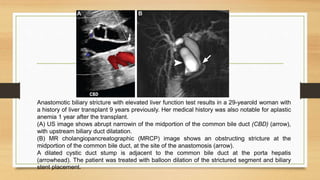 Anastomotic biliary stricture with elevated liver function test results in a 29-yearold woman with
a history of liver transplant 9 years previously. Her medical history was also notable for aplastic
anemia 1 year after the transplant.
(A) US image shows abrupt narrowin of the midportion of the common bile duct (CBD) (arrow),
with upstream biliary duct dilatation.
(B) MR cholangiopancreatographic (MRCP) image shows an obstructing stricture at the
midportion of the common bile duct, at the site of the anastomosis (arrow).
A dilated cystic duct stump is adjacent to the common bile duct at the porta hepatis
(arrowhead). The patient was treated with balloon dilation of the strictured segment and biliary
stent placement.
 