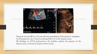 Transient elevated RI in a 44-year-old man immediately following liver transplant.
(A) Postoperative day 0 shows an elevated RI (1.0) in the hepatic artery
(B) Findings of CEUS performed at the bedside confirm the patency of the
hepatic artery at the porta hepatis (white arrow).
 