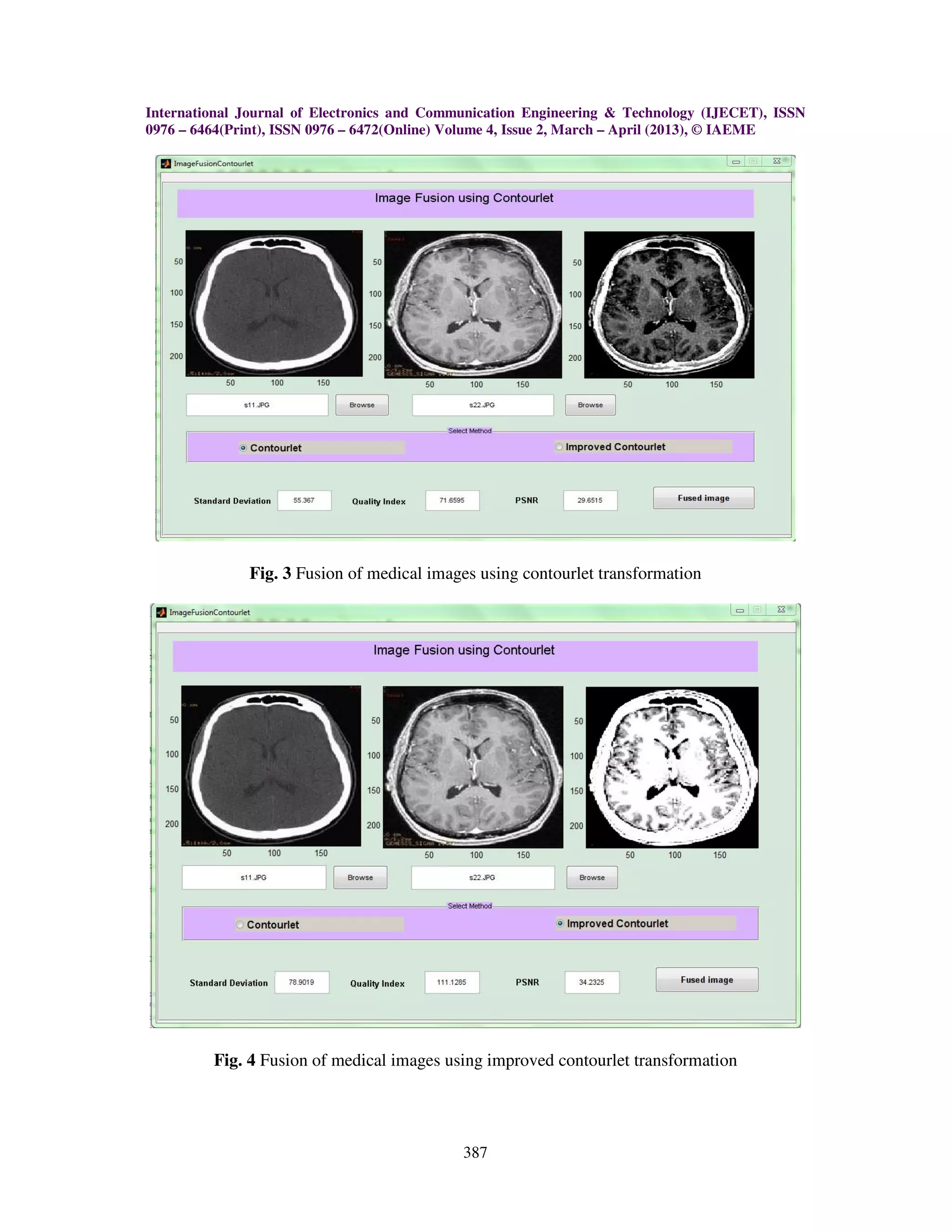International Journal of Electronics and Communication Engineering & Technology (IJECET), ISSN
0976 – 6464(Print), ISSN 0976 – 6472(Online) Volume 4, Issue 2, March – April (2013), © IAEME
387
Fig. 3 Fusion of medical images using contourlet transformation
Fig. 4 Fusion of medical images using improved contourlet transformation
 