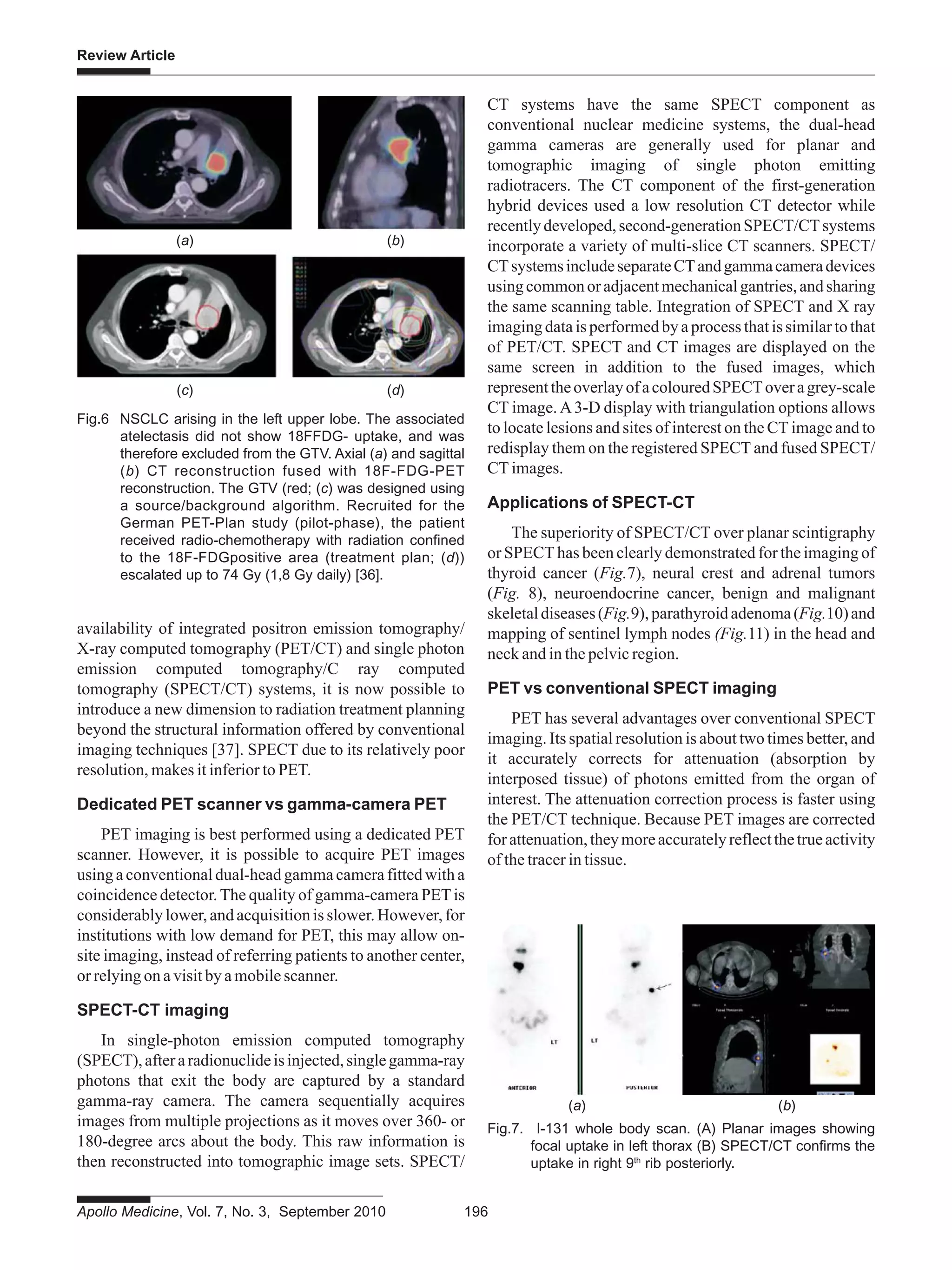 Apollo Medicine, Vol. 7, No. 3, September 2010 196
Review Article
availability of integrated positron emission tomography/
X-ray computed tomography (PET/CT) and single photon
emission computed tomography/C ray computed
tomography (SPECT/CT) systems, it is now possible to
introduce a new dimension to radiation treatment planning
beyond the structural information offered by conventional
imaging techniques [37]. SPECT due to its relatively poor
resolution, makes it inferior to PET.
Dedicated PET scanner vs gamma-camera PET
PET imaging is best performed using a dedicated PET
scanner. However, it is possible to acquire PET images
usingaconventionaldual-headgammacamerafittedwitha
coincidence detector.The quality of gamma-camera PETis
considerablylower,andacquisitionisslower.However,for
institutions with low demand for PET, this may allow on-
site imaging, instead of referring patients to another center,
or relying on a visit by a mobile scanner.
SPECT-CT imaging
In single-photon emission computed tomography
(SPECT),afteraradionuclideisinjected,singlegamma-ray
photons that exit the body are captured by a standard
gamma-ray camera. The camera sequentially acquires
images from multiple projections as it moves over 360- or
180-degree arcs about the body. This raw information is
then reconstructed into tomographic image sets. SPECT/
CT systems have the same SPECT component as
conventional nuclear medicine systems, the dual-head
gamma cameras are generally used for planar and
tomographic imaging of single photon emitting
radiotracers. The CT component of the first-generation
hybrid devices used a low resolution CT detector while
recentlydeveloped,second-generationSPECT/CTsystems
incorporate a variety of multi-slice CT scanners. SPECT/
CTsystemsincludeseparateCTandgammacameradevices
usingcommonoradjacentmechanicalgantries,andsharing
the same scanning table. Integration of SPECT and X ray
imagingdataisperformedbyaprocessthatissimilartothat
of PET/CT. SPECT and CT images are displayed on the
same screen in addition to the fused images, which
representtheoverlayofacolouredSPECToveragrey-scale
CT image. A3-D display with triangulation options allows
to locate lesions and sites of interest on the CT image and to
redisplay them on the registered SPECT and fused SPECT/
CT images.
Applications of SPECT-CT
The superiority of SPECT/CT over planar scintigraphy
or SPECT has been clearly demonstrated for the imaging of
thyroid cancer (Fig.7), neural crest and adrenal tumors
(Fig. 8), neuroendocrine cancer, benign and malignant
skeletaldiseases(Fig.9),parathyroidadenoma(Fig.10)and
mapping of sentinel lymph nodes (Fig.11) in the head and
neck and in the pelvic region.
PET vs conventional SPECT imaging
PET has several advantages over conventional SPECT
imaging. Its spatial resolution is about two times better, and
it accurately corrects for attenuation (absorption by
interposed tissue) of photons emitted from the organ of
interest. The attenuation correction process is faster using
the PET/CT technique. Because PET images are corrected
forattenuation,theymoreaccuratelyreflectthetrueactivity
of the tracer in tissue.
(a) (b)
(c) (d)
Fig.6 NSCLC arising in the left upper lobe. The associated
atelectasis did not show 18FFDG- uptake, and was
therefore excluded from the GTV. Axial (a) and sagittal
(b) CT reconstruction fused with 18F-FDG-PET
reconstruction. The GTV (red; (c) was designed using
a source/background algorithm. Recruited for the
German PET-Plan study (pilot-phase), the patient
received radio-chemotherapy with radiation confined
to the 18F-FDGpositive area (treatment plan; (d))
escalated up to 74 Gy (1,8 Gy daily) [36].
Fig.7. I-131 whole body scan. (A) Planar images showing
focal uptake in left thorax (B) SPECT/CT confirms the
uptake in right 9th
rib posteriorly.
(a) (b)
 