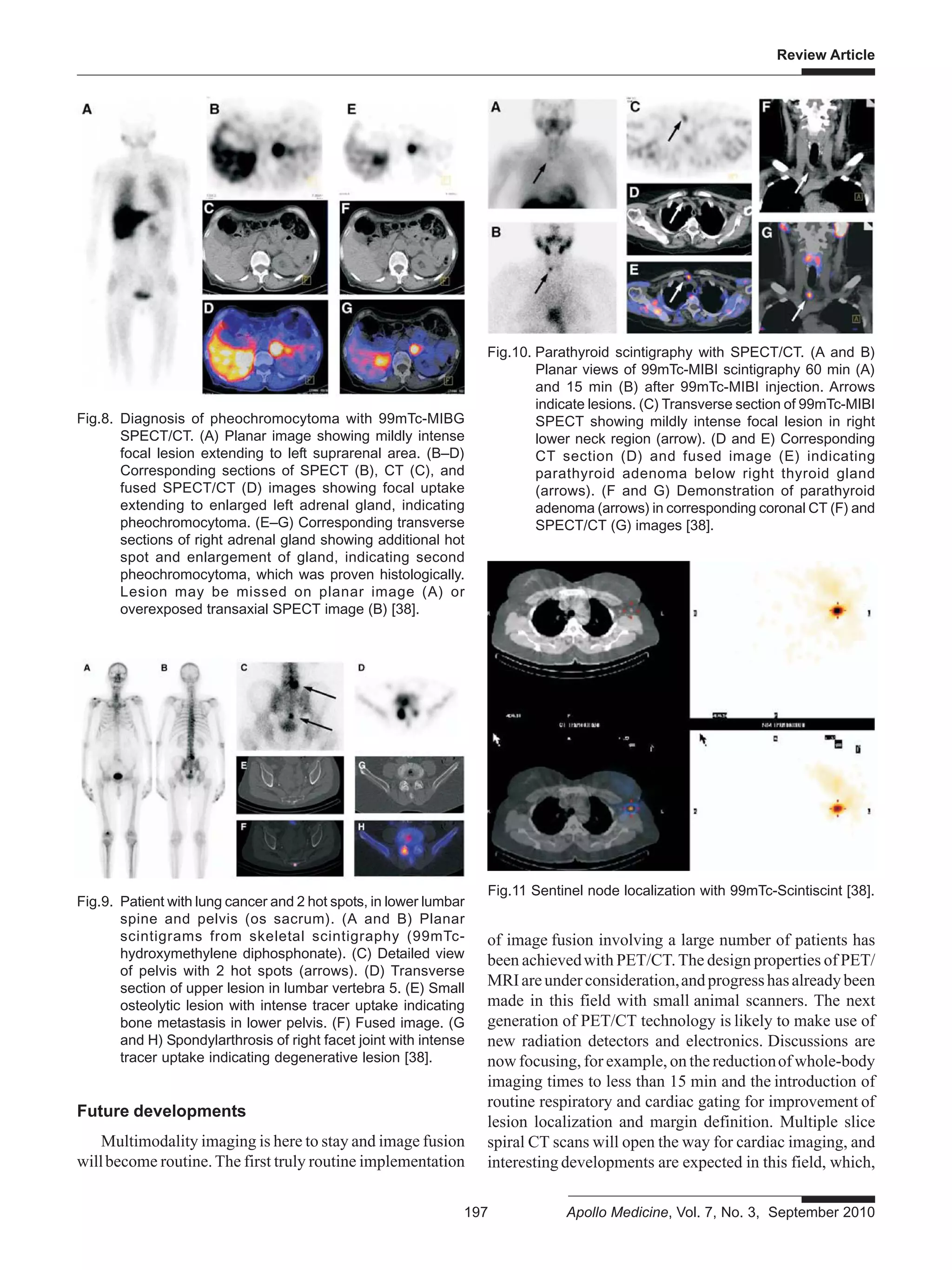 Review Article
197 Apollo Medicine, Vol. 7, No. 3, September 2010
Fig.9. Patient with lung cancer and 2 hot spots, in lower lumbar
spine and pelvis (os sacrum). (A and B) Planar
scintigrams from skeletal scintigraphy (99mTc-
hydroxymethylene diphosphonate). (C) Detailed view
of pelvis with 2 hot spots (arrows). (D) Transverse
section of upper lesion in lumbar vertebra 5. (E) Small
osteolytic lesion with intense tracer uptake indicating
bone metastasis in lower pelvis. (F) Fused image. (G
and H) Spondylarthrosis of right facet joint with intense
tracer uptake indicating degenerative lesion [38].
Fig.8. Diagnosis of pheochromocytoma with 99mTc-MIBG
SPECT/CT. (A) Planar image showing mildly intense
focal lesion extending to left suprarenal area. (B–D)
Corresponding sections of SPECT (B), CT (C), and
fused SPECT/CT (D) images showing focal uptake
extending to enlarged left adrenal gland, indicating
pheochromocytoma. (E–G) Corresponding transverse
sections of right adrenal gland showing additional hot
spot and enlargement of gland, indicating second
pheochromocytoma, which was proven histologically.
Lesion may be missed on planar image (A) or
overexposed transaxial SPECT image (B) [38].
Fig.10. Parathyroid scintigraphy with SPECT/CT. (A and B)
Planar views of 99mTc-MIBI scintigraphy 60 min (A)
and 15 min (B) after 99mTc-MIBI injection. Arrows
indicate lesions. (C) Transverse section of 99mTc-MIBI
SPECT showing mildly intense focal lesion in right
lower neck region (arrow). (D and E) Corresponding
CT section (D) and fused image (E) indicating
parathyroid adenoma below right thyroid gland
(arrows). (F and G) Demonstration of parathyroid
adenoma (arrows) in corresponding coronal CT (F) and
SPECT/CT (G) images [38].
of image fusion involving a large number of patients has
been achievedwith PET/CT. The design properties of PET/
MRIareunderconsideration,andprogresshasalreadybeen
made in this field with small animal scanners. The next
generation of PET/CT technology is likely to make use of
new radiation detectors and electronics. Discussions are
now focusing, for example, on the reductionof whole-body
imaging times to less than 15 min and the introduction of
routine respiratory and cardiac gating for improvement of
lesion localization and margin definition. Multiple slice
spiral CT scans will open the way for cardiac imaging, and
interesting developments are expected in this field, which,
Future developments
Multimodality imaging is here to stay and image fusion
willbecome routine. The first truly routine implementation
Fig.11 Sentinel node localization with 99mTc-Scintiscint [38].
 