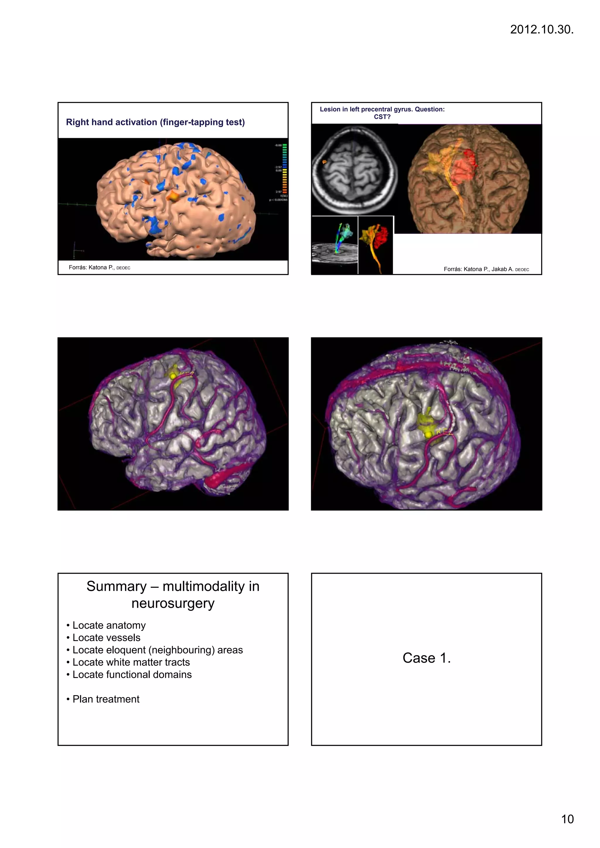 2012.10.30.




                                              Lesion in left precentral gyrus. Question:
                                                                 CST?
Right hand activation (finger-tapping test)




Forrás: Katona P., DEOEC                                                               Forrás: Katona P., Jakab A. DEOEC




      Summary – multimodality in
           neurosurgery
• Locate anatomy
• Locate vessels
• Locate eloquent (neighbouring) areas
•LLocate white matter t t
      t    hit    tt tracts                                              Case 1
                                                                              1.
• Locate functional domains

• Plan treatment




                                                                                                                           10
 