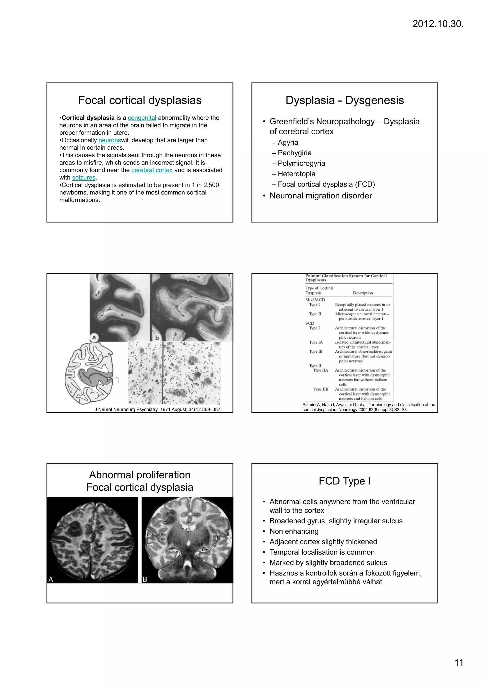 2012.10.30.




      Focal cortical dysplasias                                                  Dysplasia - Dysgenesis
•Cortical dysplasia is a congenital abnormality where the
neurons in an area of the brain failed to migrate in the                  • Greenfield’s Neuropathology – Dysplasia
proper formation in utero.                                                  of cerebral cortex
•Occasionally neuronswill develop that are larger than                      – Agyria
normal in certain areas.
•This causes the signals sent through the neurons in these                  – Pachygiria
areas to misfire, which sends an incorrect signal. It is                    – Polymicrogyria
commonly found near the cerebral cortex and is associated
with seizures.
                                                                            – Heterotopia
•Cortical dysplasia is estimated to be present in 1 in 2,500                – Focal cortical dysplasia (FCD)
newborns, making it one of the most common cortical
malformations.
                                                                          • Neuronal migration disorder




                                                                                      Palmini A, Najm I, Avanzini G, et al. Terminology and classification of the
            J Neurol Neurosurg Psychiatry. 1971 August; 34(4): 369–387.               cortical dysplasias. Neurology 2004;62(6 suppl 3):S2–S8.




         Abnormal proliferation
                                                                                               FCD Type I
         Focal cortical dysplasia
                                                                          • Abnormal cells anywhere from the ventricular
                                                                            wall to the cortex
                                                                          • Broadened gyrus, slightly irregular sulcus
                                                                          • Non enhancing
                                                                          • Adjacent cortex slightly thickened
                                                                          • Temporal localisation is common
                                                                          • Marked by slightly broadened sulcus
                                                                          • Hasznos a kontrollok során a fokozott figyelem,
                                                                            mert a korral egyértelmübbé válhat




                                                                                                                                                                    11
 