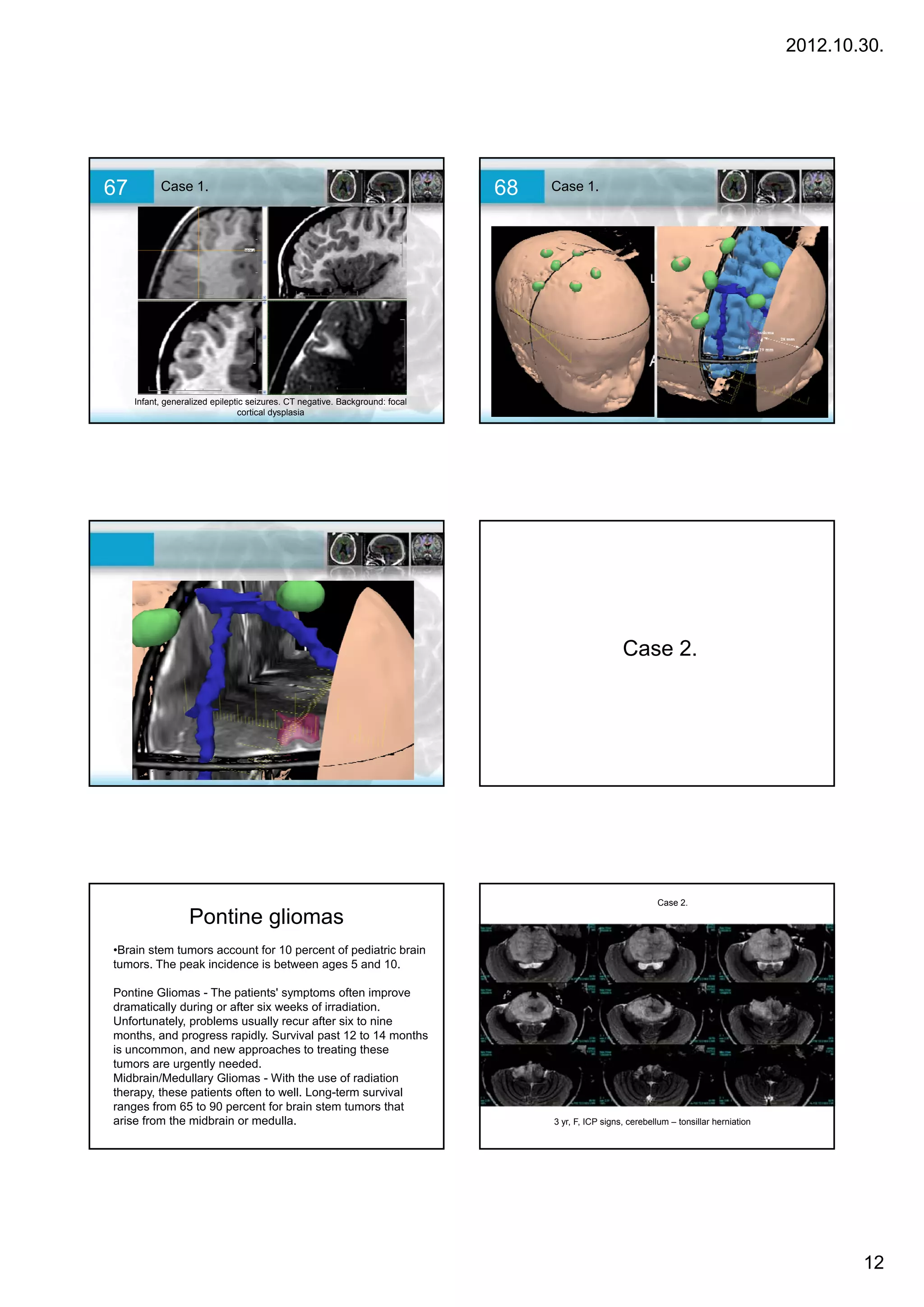 2012.10.30.




67         Case 1.                                                            68   Case 1.




     Infant, generalized epileptic seizures. CT negative. Background: focal
                                cortical dysplasia




                                                                                                     Case 2
                                                                                                          2.




                                                                                                              Case 2.

                   Pontine gliomas
•Brain stem tumors account for 10 percent of pediatric brain
tumors. The peak incidence is between ages 5 and 10.

Pontine Gliomas - The patients' symptoms often improve
dramatically during or after six weeks of irradiation.
Unfortunately, problems usually recur after six to nine
months, and progress rapidly. Survival past 12 to 14 months
is uncommon, and new approaches to treating these
tumors are urgently needed.
Midbrain/Medullary Gliomas - With the use of radiation
therapy, these patients often to well. Long-term survival
ranges from 65 to 90 percent for brain stem tumors that
arise from the midbrain or medulla.                                                3 yr, F, ICP signs, cerebellum – tonsillar herniation




                                                                                                                                                   12
 