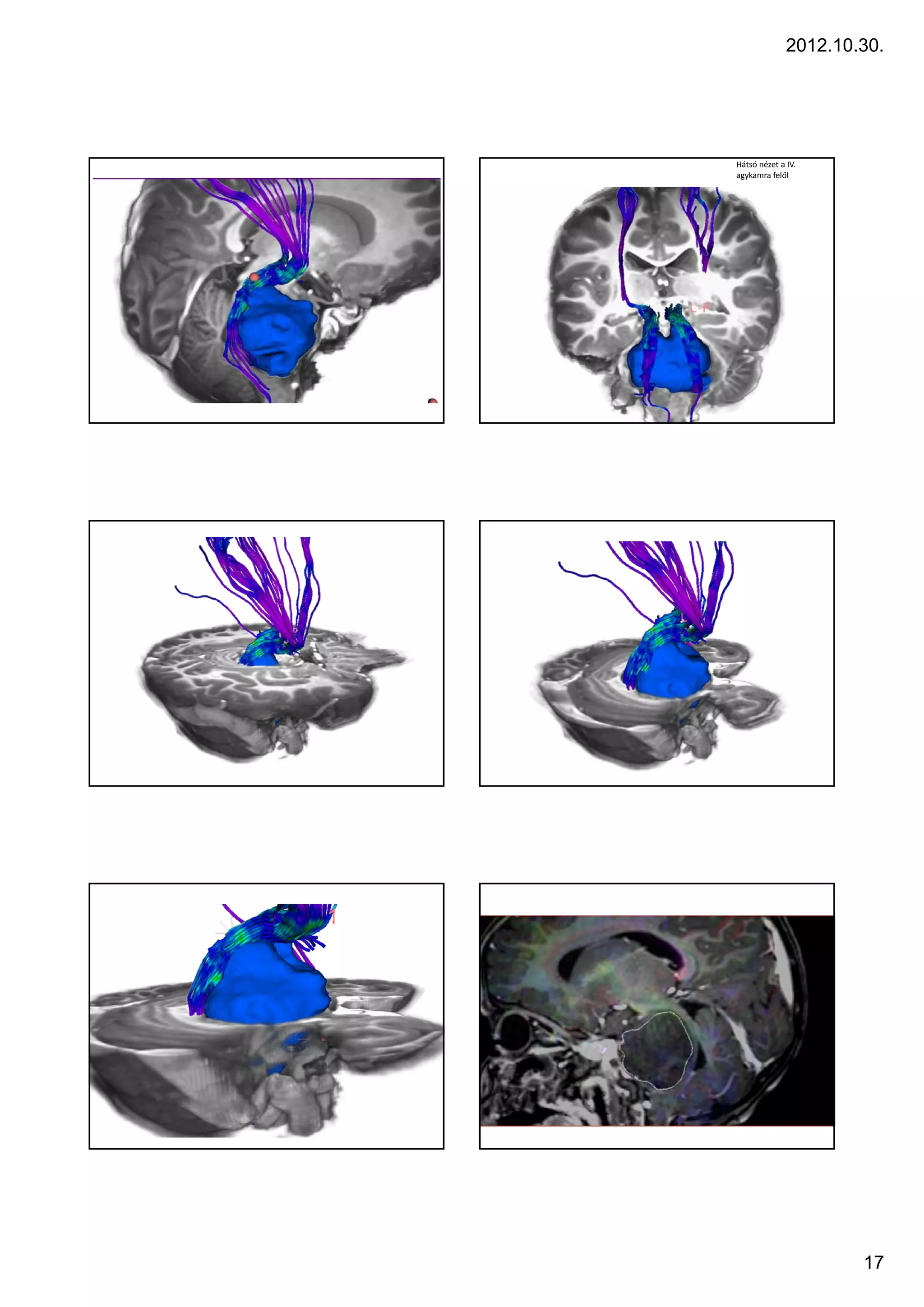 2012.10.30.




Hátsó nézet a IV.
agykamra felől




                      17
 