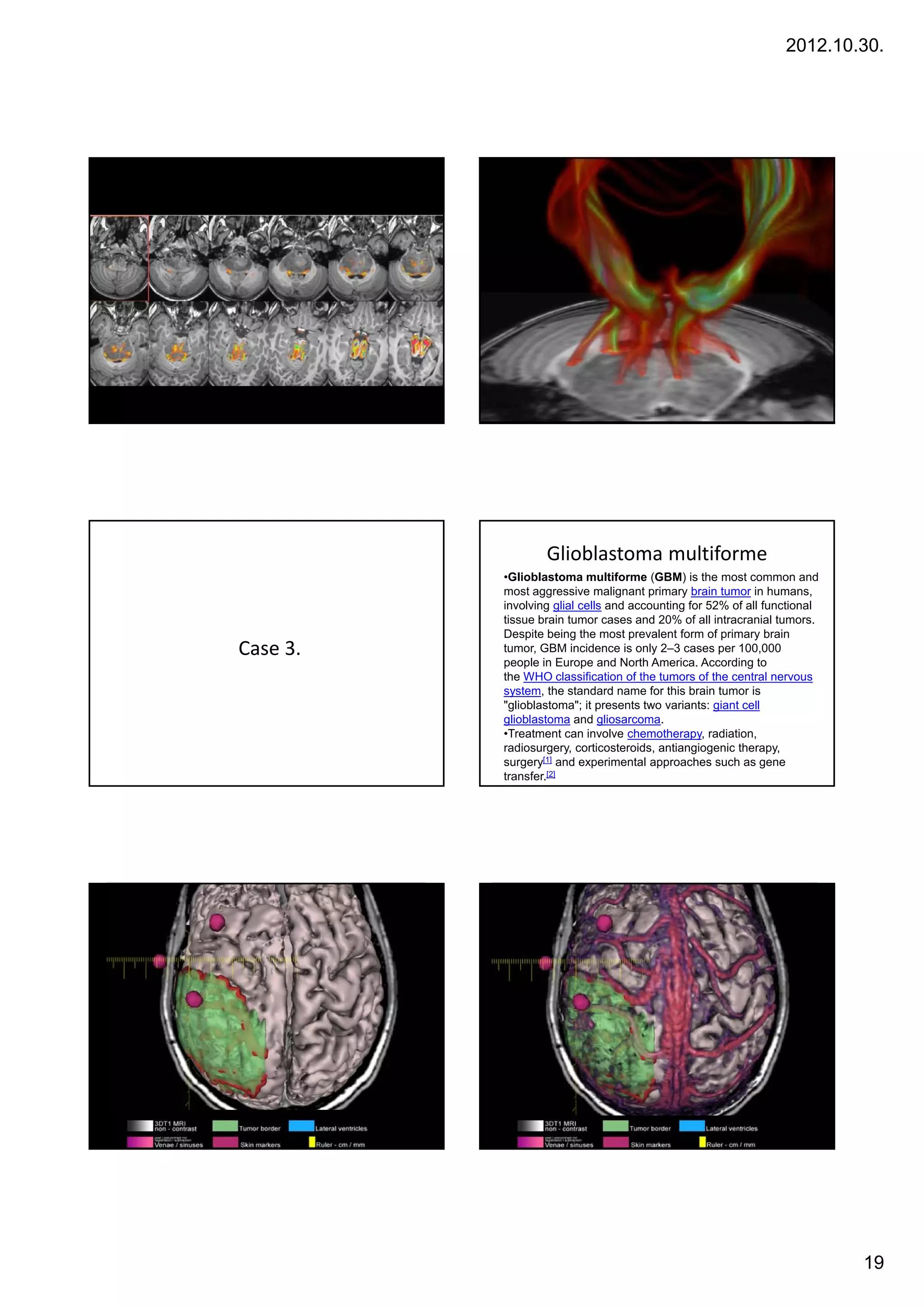2012.10.30.




                  Glioblastoma multiforme
          •Glioblastoma multiforme (GBM) is the most common and
          most aggressive malignant primary brain tumor in humans,
          involving glial cells and accounting for 52% of all functional
          tissue brain tumor cases and 20% of all intracranial tumors.
          Despite being the most prevalent form of primary brain
Case 3.   tumor, GBM incidence is only 2–3 cases per 100,000
                ,                       y            p       ,
          people in Europe and North America. According to
          the WHO classification of the tumors of the central nervous
          system, the standard name for this brain tumor is
          "glioblastoma"; it presents two variants: giant cell
          glioblastoma and gliosarcoma.
          •Treatment can involve chemotherapy, radiation,
          radiosurgery, corticosteroids, antiangiogenic therapy,
          surgery[1] and experimental approaches such as gene
          transfer.[2]




                                                                           19
 