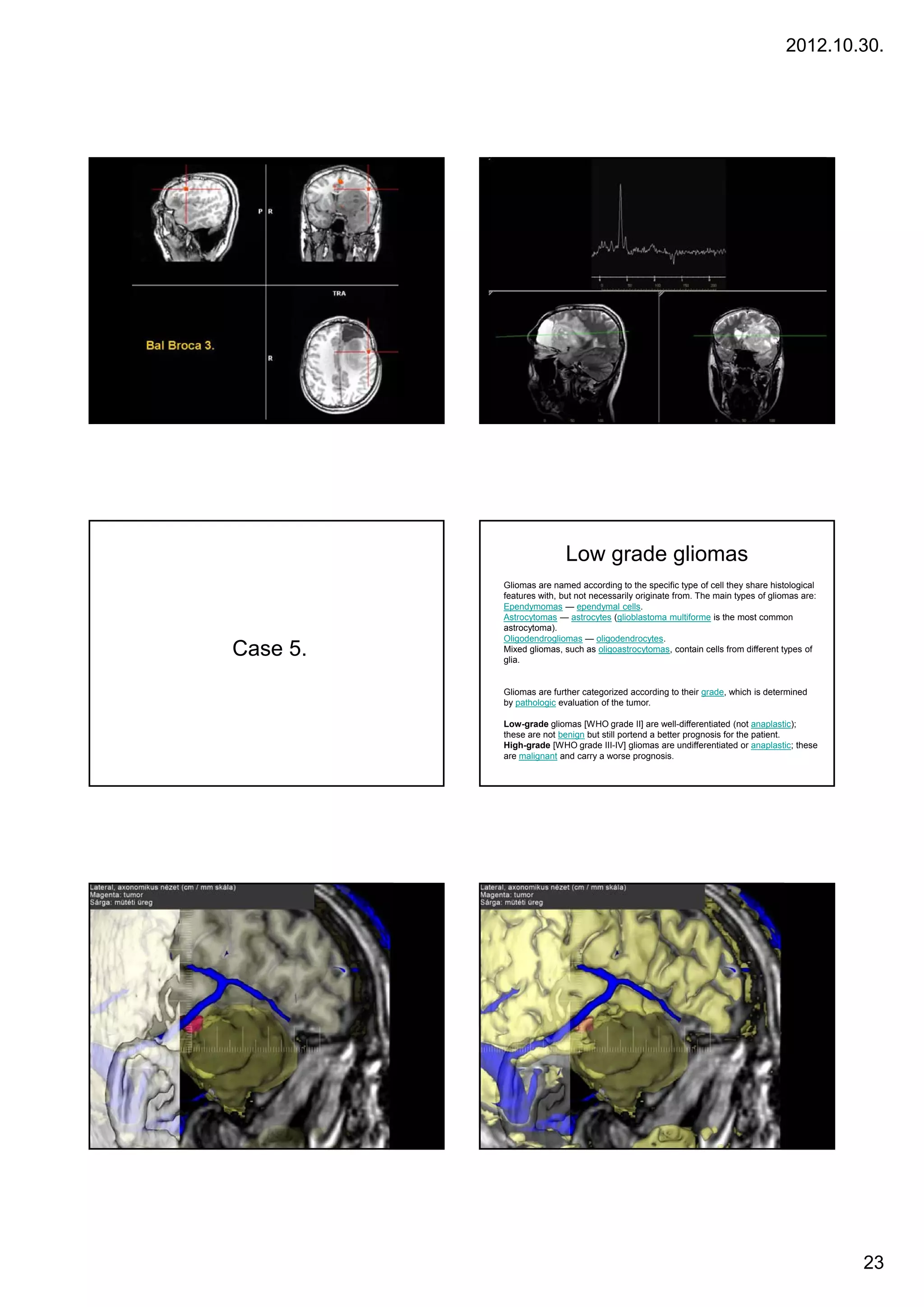 2012.10.30.




                          Low grade gliomas
          Gliomas are named according to the specific type of cell they share histological
          features with, but not necessarily originate from. The main types of gliomas are:
          Ependymomas — ependymal cells.
          Astrocytomas — astrocytes (glioblastoma multiforme is the most common
          astrocytoma).
          Oligodendrogliomas — oligodendrocytes.
Case 5
     5.   Mixed gliomas, such as oligoastrocytomas, contain cells from different types of
          glia.
                 g       ,           g        y       ,                            yp



          Gliomas are further categorized according to their grade, which is determined
          by pathologic evaluation of the tumor.

          Low-grade gliomas [WHO grade II] are well-differentiated (not anaplastic);
          these are not benign but still portend a better prognosis for the patient.
          High-grade [WHO grade III-IV] gliomas are undifferentiated or anaplastic; these
          are malignant and carry a worse prognosis.




                                                                                              23
 
