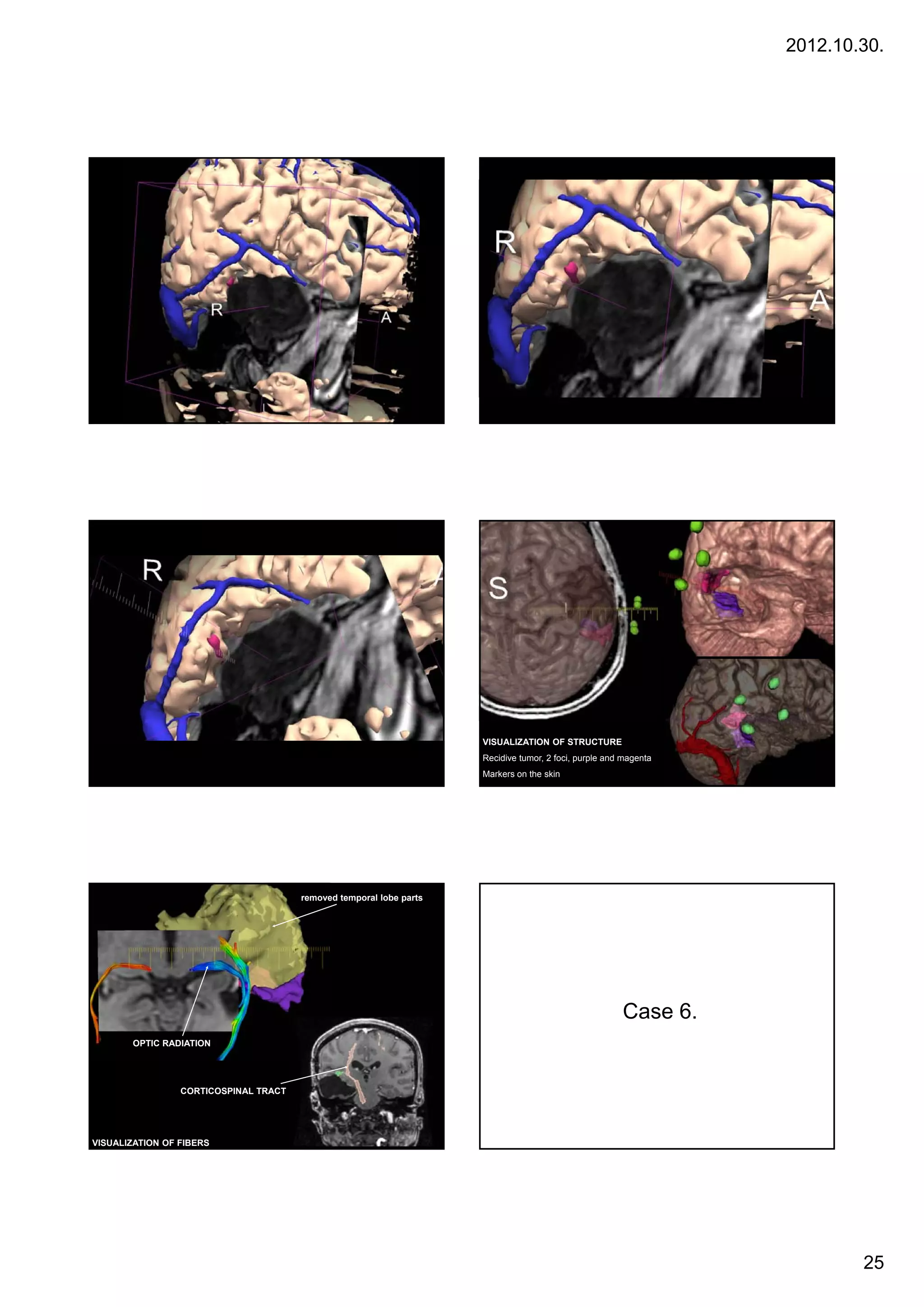 2012.10.30.




                                                                     VISUALIZATION OF STRUCTURE
                                                                     Recidive tumor, 2 foci, purple and magenta
                                                                     Markers on the skin




                                       removed temporal lobe parts




                                                                                                       Case 6
                                                                                                            6.
       OPTIC RADIATION




                 CORTICOSPINAL TRACT




VISUALIZATION OF FIBERS




                                                                                                                          25
 