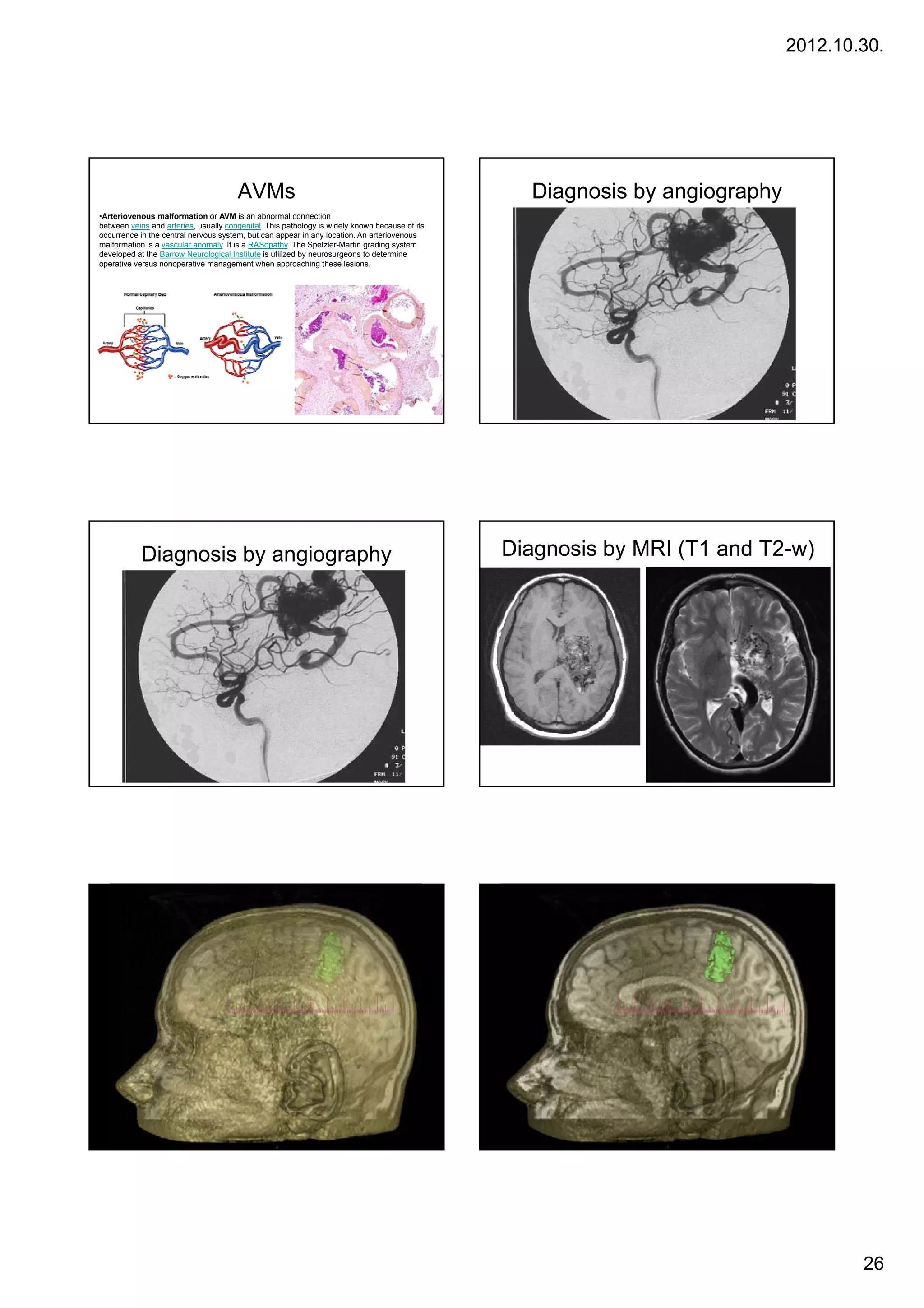 2012.10.30.




                                       AVMs                                                       Diagnosis by angiography
•Arteriovenous malformation or AVM is an abnormal connection
between veins and arteries, usually congenital. This pathology is widely known because of its
occurrence in the central nervous system, but can appear in any location. An arteriovenous
malformation is a vascular anomaly. It is a RASopathy. The Spetzler-Martin grading system
developed at the Barrow Neurological Institute is utilized by neurosurgeons to determine
operative versus nonoperative management when approaching these lesions.




            Diagnosis by angiography                                                            Diagnosis by MRI (T1 and T2-w)




                                                                                                                                     26
 