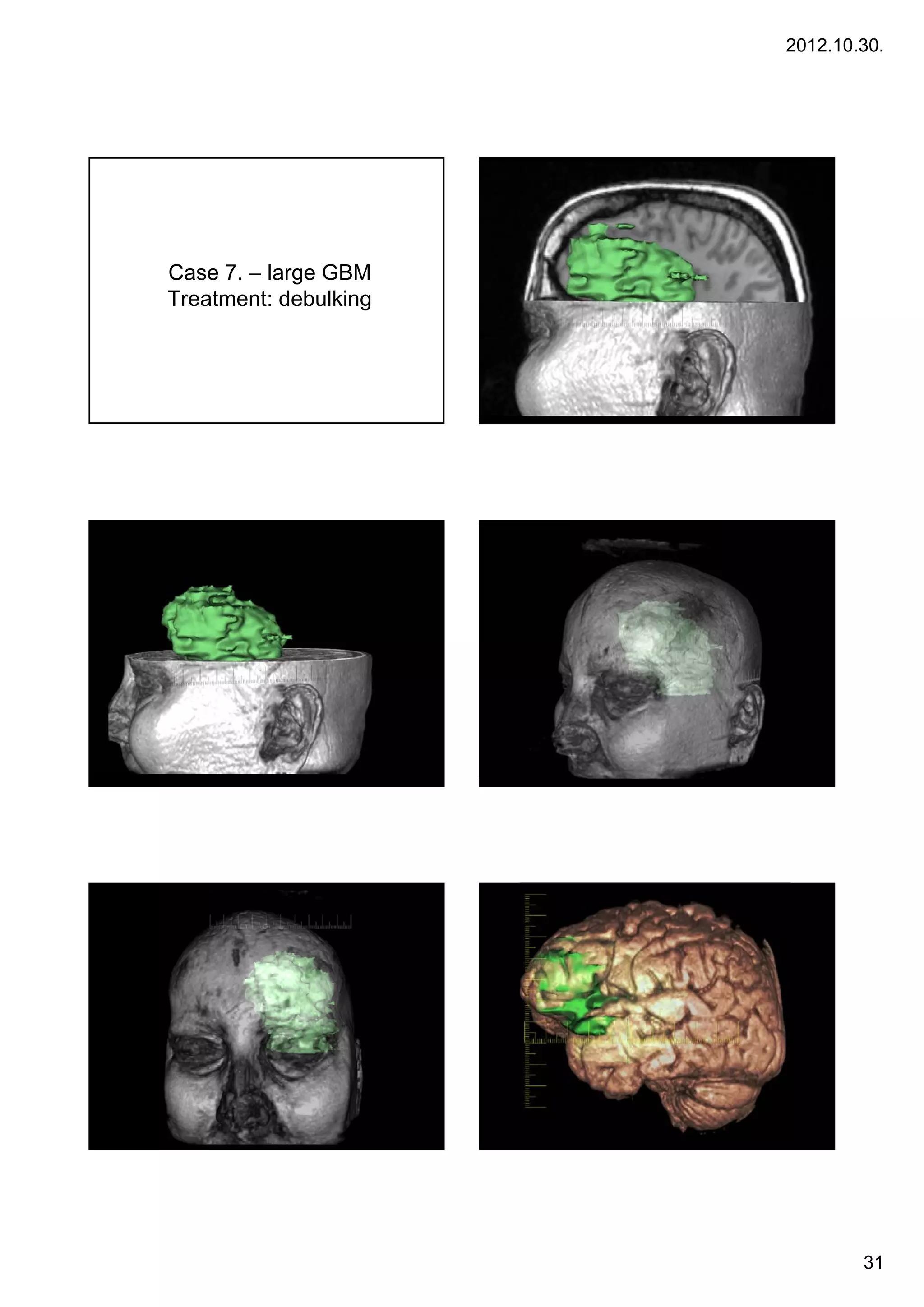 2012.10.30.




Case 7. – large GBM
Treatment: d b lki
T           debulking




                                31
 