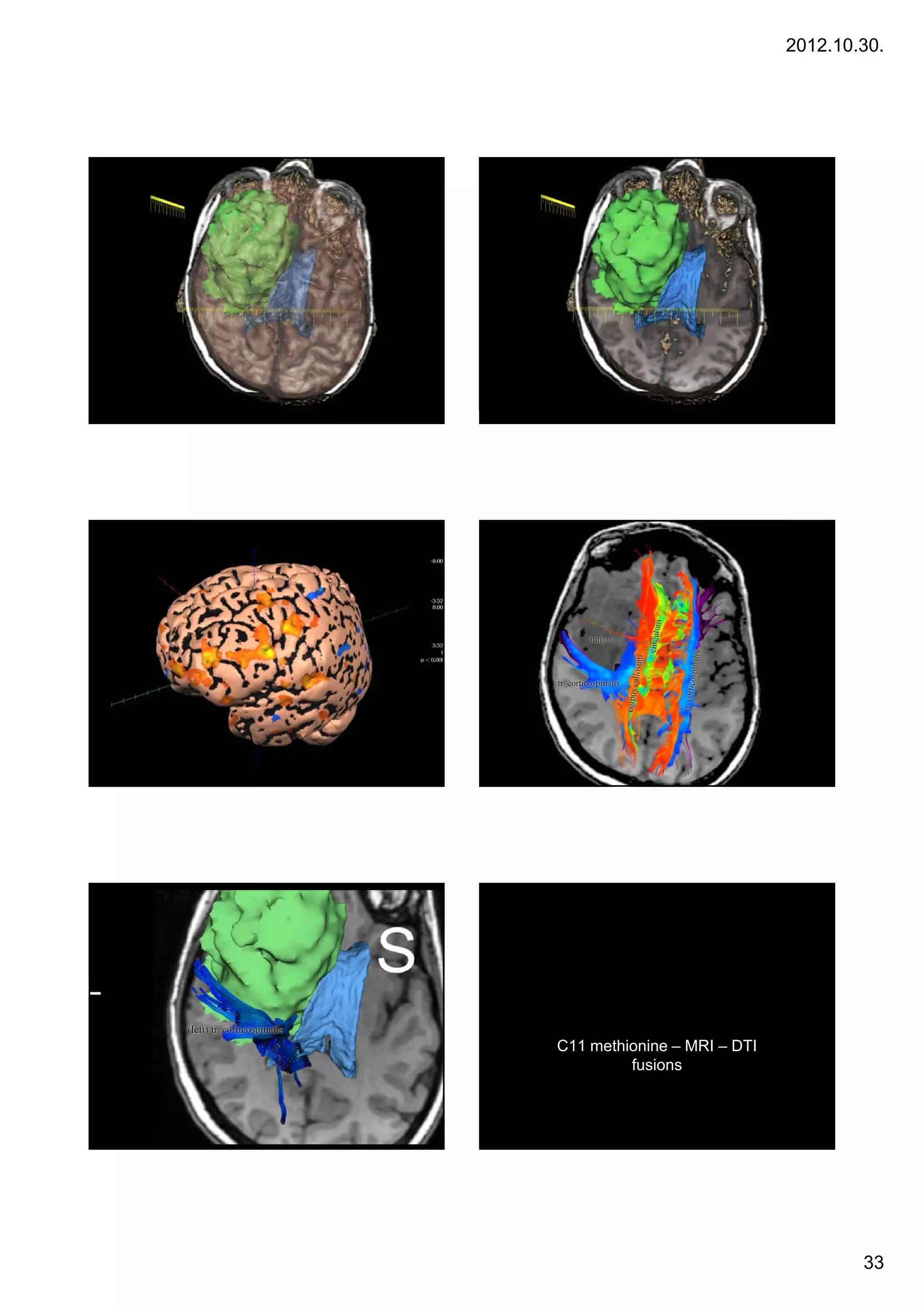 2012.10.30.




C11 methionine – MRI – DTI
         fusions




                                     33
 