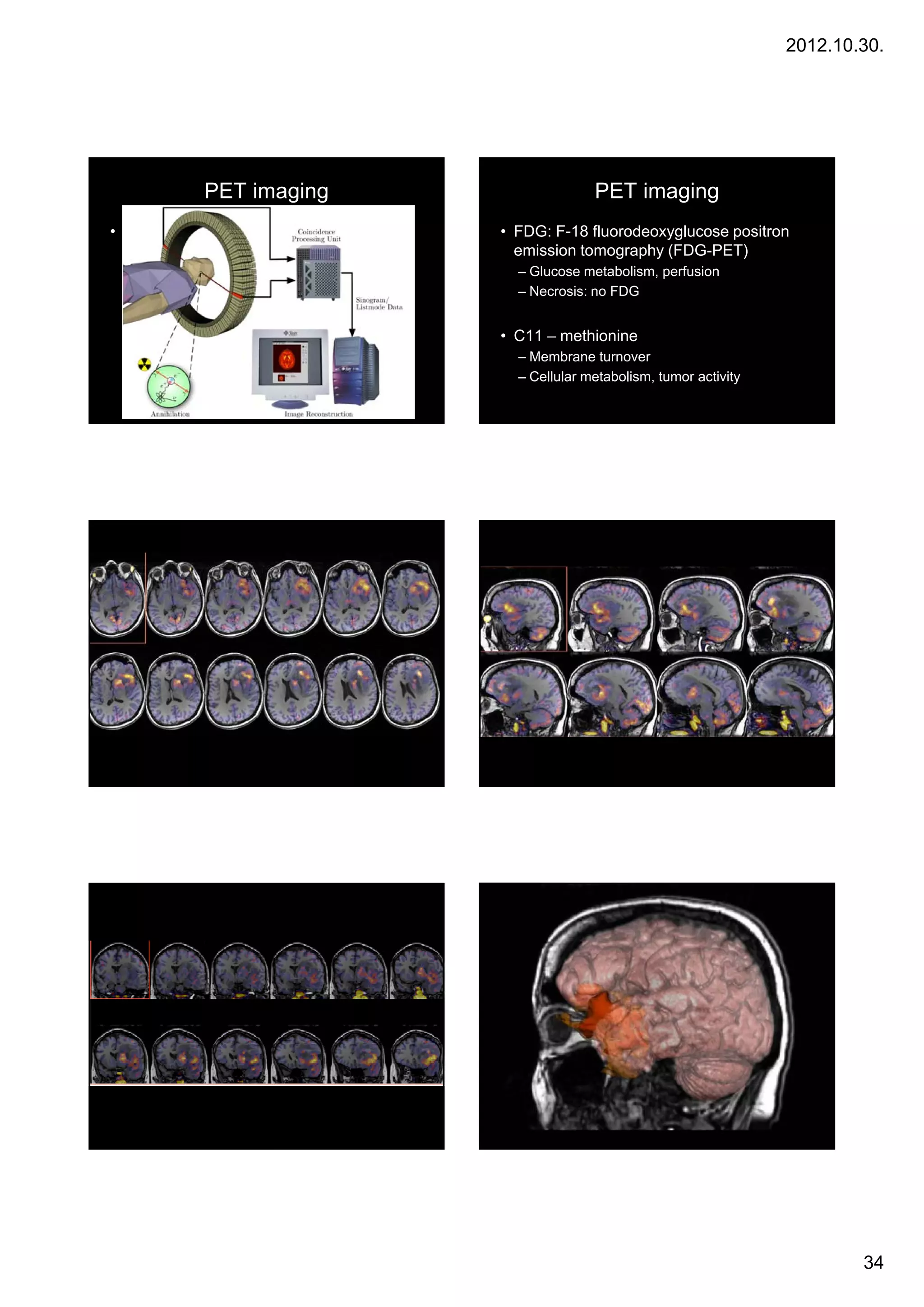 2012.10.30.




           PET imaging                 PET imaging
• fdsfsd                 • FDG: F-18 fluorodeoxyglucose positron
                           emission tomography (FDG-PET)
                           – Glucose metabolism, perfusion
                           – Necrosis: no FDG


                         • C11 – methionine
                           – Membrane turnover
                           – Cellular metabolism, tumor activity




                                                                           34
 