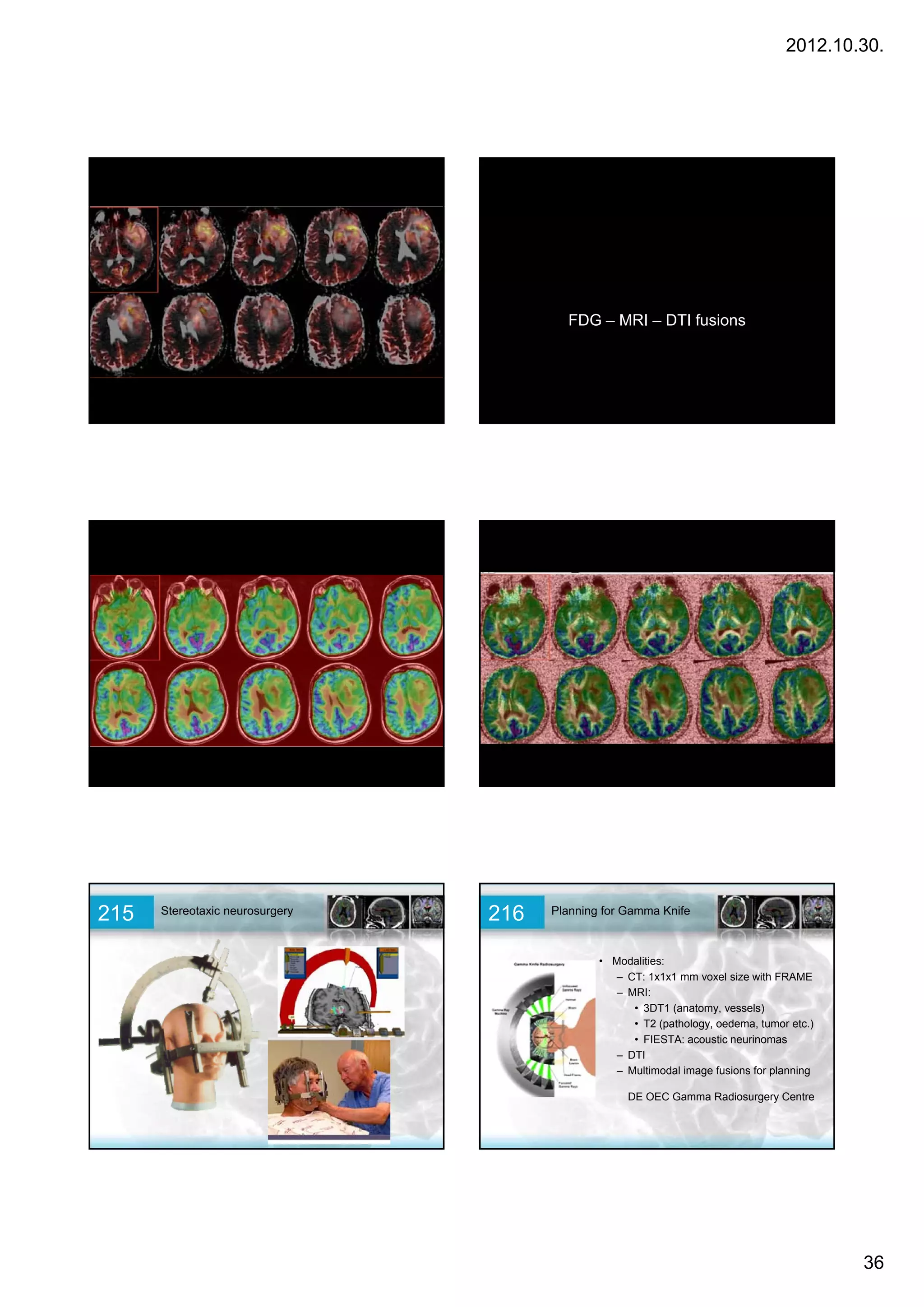 2012.10.30.




                                         FDG – MRI – DTI fusions




215   Stereotaxic neurosurgery   216   Planning for Gamma Knife



                                               • Modalities:
                                                 – CT: 1x1x1 mm voxel size with FRAME
                                                 – MRI:
                                                    • 3DT1 (anatomy, vessels)
                                                    • T2 (pathology, oedema, tumor etc.)
                                                    • FIESTA: acoustic neurinomas
                                                 – DTI
                                                 – Multimodal image fusions for planning

                                                    DE OEC Gamma Radiosurgery Centre




                                                                                           36
 