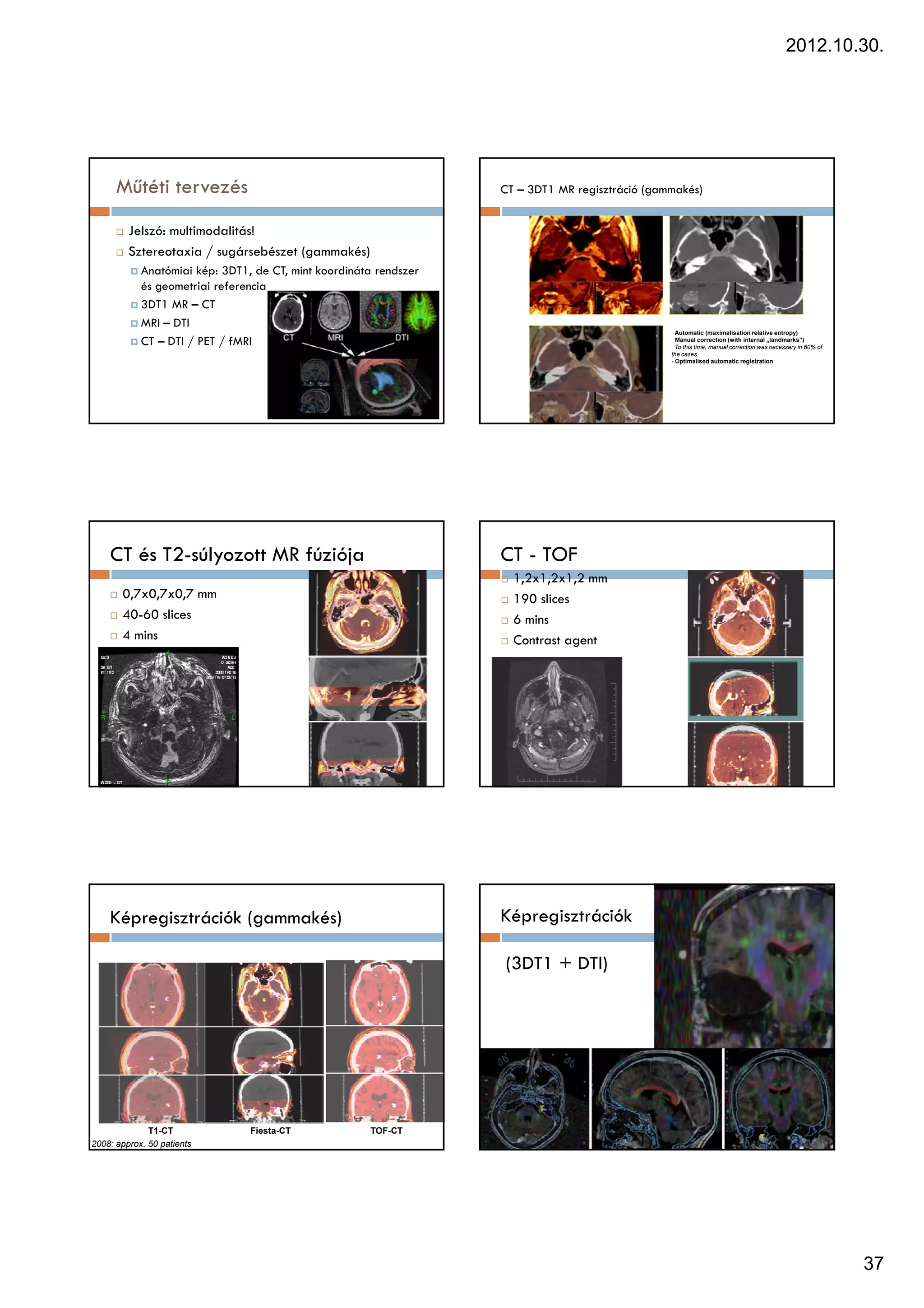2012.10.30.




      Műtéti tervezés                                              CT – 3DT1 MR regisztráció (gammakés)


         Jelszó: multimodalitás!
         Sztereotaxia / sugársebészet (gammakés)
            Anatómiai kép: 3DT1, de CT, mint koordináta rendszer
            és geometriai referencia
               g
            3DT1 MR – CT
            MRI – DTI
                                                                                                 - Automatic (maximalisation relative entropy)
            CT – DTI / PET / fMRI                                                                - Manual correction (with internal „landmarks”)
                                                                                                   To this time, manual correction was necessary in 60% of
                                                                                                 the cases
                                                                                                 - Optimalised automatic registration




    CT és T2-súlyozott MR fúziója                                  CT - TOF
                                                                     1,2x1,2x1,2 mm
       0,7x0,7x0,7 mm                                                190 slices
       40-60 slices                                                  6 mins
       4 mins                                                        Contrast agent




    Képregisztrációk (gammakés)                                    Képregisztrációk

                                                                   (3DT1 + DTI)




              T1-CT             Fiesta-CT             TOF-CT
2008: approx. 50 patients




                                                                                                                                                             37
 