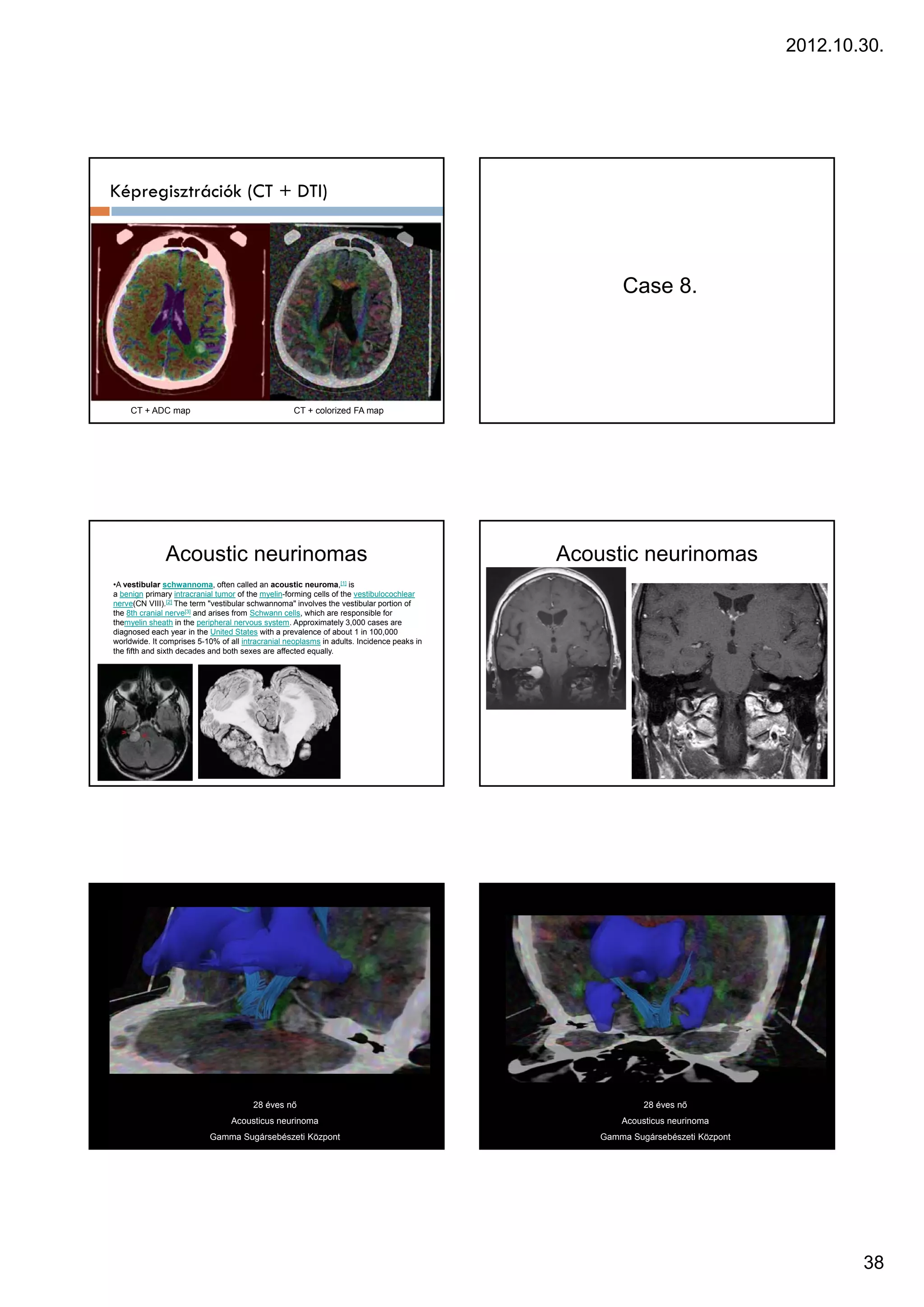 2012.10.30.




Képregisztrációk (CT + DTI)



                                                                                                    Case 8
                                                                                                         8.




     CT + ADC map                                   CT + colorized FA map




               Acoustic neurinomas                                                          Acoustic neurinomas
•A vestibular schwannoma, often called an acoustic neuroma,[1] is
a benign primary intracranial tumor of the myelin-forming cells of the vestibulocochlear
nerve(CN VIII).[2] The term "vestibular schwannoma" involves the vestibular portion of
the 8th cranial nerve[3] and arises from Schwann cells, which are responsible for
themyelin sheath in the peripheral nervous system. Approximately 3,000 cases are
diagnosed each year in the United States with a prevalence of about 1 in 100,000
worldwide. It comprises 5-10% of all intracranial neoplasms in adults. Incidence peaks in
the fifth and sixth decades and both sexes are affected equally.




                                        28 éves nő                                                       28 éves nő
                                  Acousticus neurinoma                                              Acousticus neurinoma
                           Gamma Sugársebészeti Központ                                         Gamma Sugársebészeti Központ




                                                                                                                                       38
 