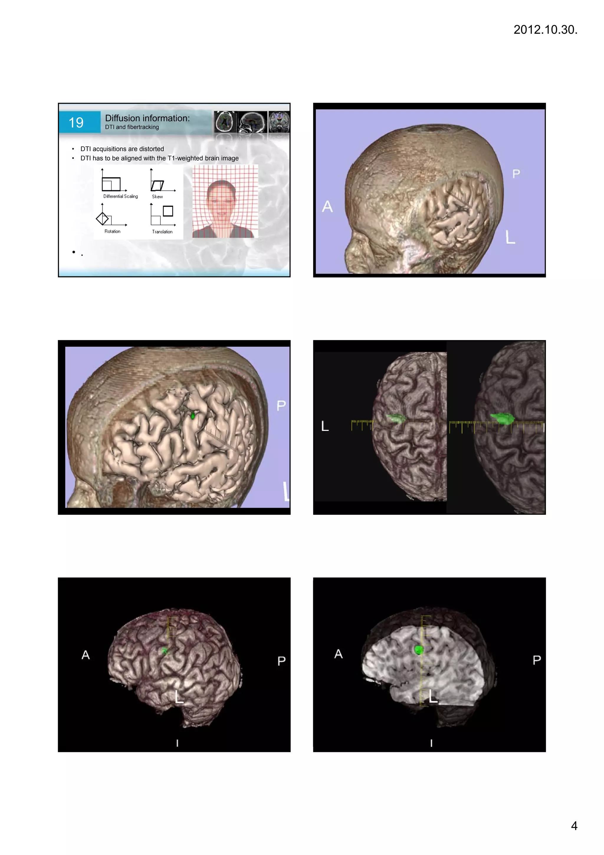 2012.10.30.




           Diffusion information:
19         DTI and fibertracking


• DTI acquisitions are distorted
• DTI has to be aligned with the T1-weighted brain image




• .




                                                                    4
 