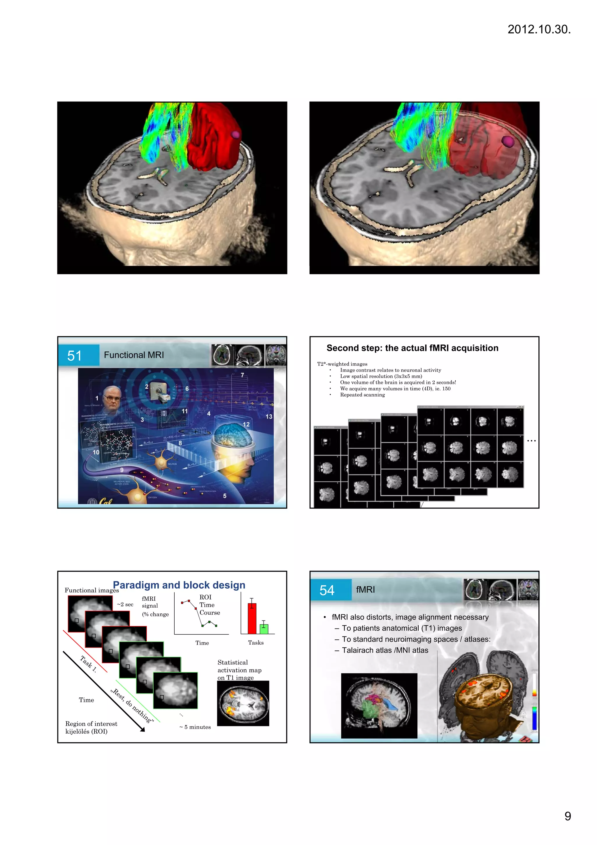2012.10.30.




             Bevezetés                                                                  Bevezetés
49           A multimodális képalkotás alapjai                           50             A multimodális képalkotás alapjai




                                                                            Second step: the actual fMRI acquisition
51           Functional MRI
                                                                         T2*-weighted images
                                                                             •   Image contrast relates to neuronal activity
                                                                             •   Low spatial resolution (3x3x5 mm)
                                                                             •   One volume of the brain is acquired in 2 seconds!
                                                                             •   We acquire many volumes in time (4D), ie. 150
                                                                             •   Repeated scanning




                                                                                                                                                     …

                                                                                                                             first volume
                                                                                                                             (2 sec to acquire)




                Paradigm and block design
Functional images
                           fMRI                   ROI
                                                                         54             fMRI
                  ~2 sec   signal                 Time
                           (% change              Course
                                                                           • fMRI also distorts, image alignment necessary
                                                                              – To patients anatomical (T1) images
                                                 Time            Tasks        – To standard neuroimaging spaces / atlases:
                                                                              – Talairach atlas /MNI atlas
                                                        Statistical
                                                        activation map
                                                        on T1 image


    Time


Region of interest                        ~ 5 minutes
kijelölés (ROI)




                                                                                                                                                           9
 