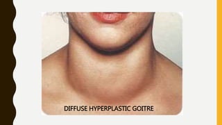 DIFFUSE HYPERPLASTIC GOITRE
 
