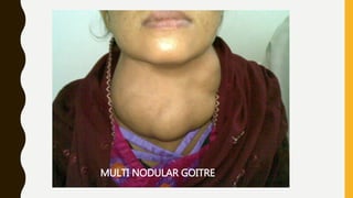MULTI NODULAR GOITRE
 