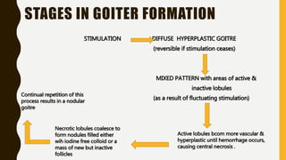 STAGES IN GOITER FORMATION
STIMULATION DIFFUSE HYPERPLASTIC GOITRE
(reversible if stimulation ceases)
MIXED PATTERN with areas of active &
inactive lobules
(as a result of fluctuating stimulation)
Active lobules bcom more vascular &
hyperplastic until hemorrhage occurs,
causing central necrosis .
Necrotic lobules coalesce to
form nodules filled either
wih iodine free colloid or a
mass of new but inactive
follicles
Continual repetition of this
process results in a nodular
goitre
 