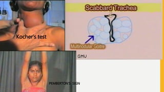 Kocher’s test
PEMBERTON’S SIGN
 