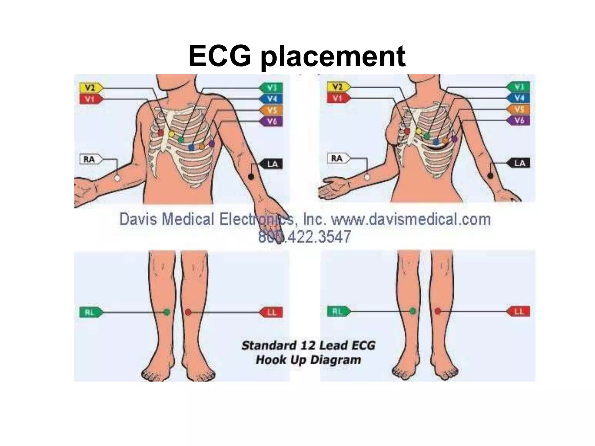 ECG placement
 