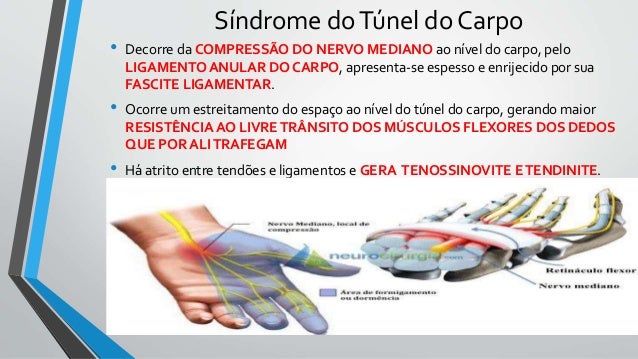 Resultado de imagem para Sindrome do túnel do carpo