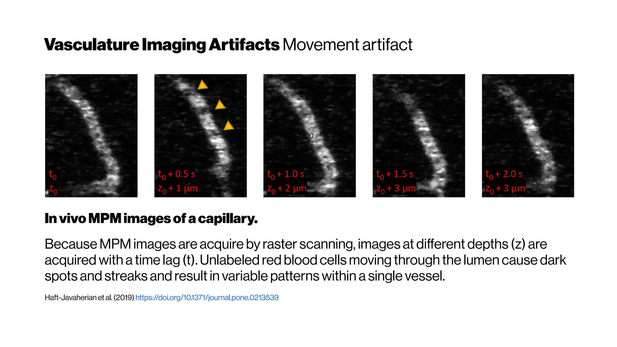 VasculatureImagingArtifacts Movement artifact
00
In vivoMPMimagesofacapillary.
Because MPM images are acquire by raster scanning, images at different depths (z) are
acquired with a time lag (t). Unlabeled red blood cells moving through the lumen cause dark
spots and streaks and result in variable patterns within a single vessel.
Haft-Javaherian et al.(2019) https://doi.org/10.1371/journal.pone.0213539
 